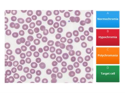 Abnormal RBCs