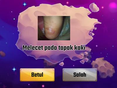 Contoh kecederaan tisu lembut?