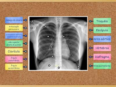 Anatomia de radiografia do tórax