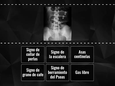 Signos de Rx de abdomen