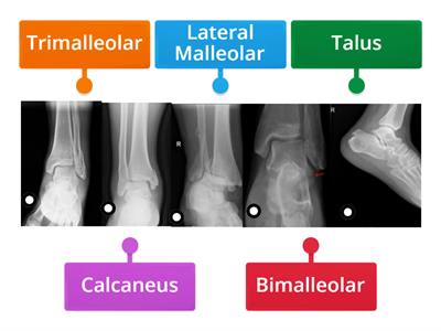 Ankle Fractures