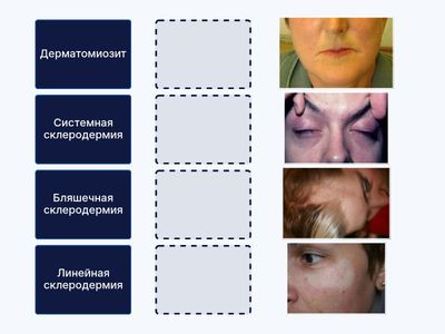 Заболевания соединительной ткани