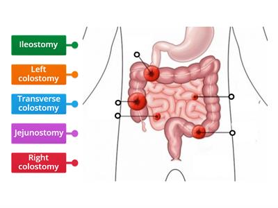 Ostomy Locations