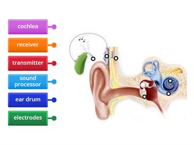 cochlear implant 