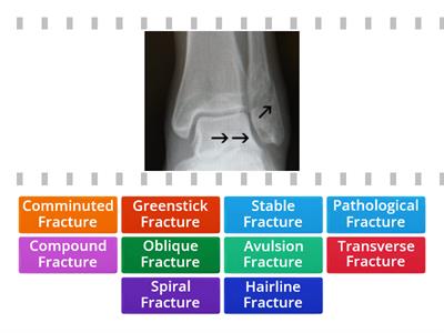 Types of Fractures