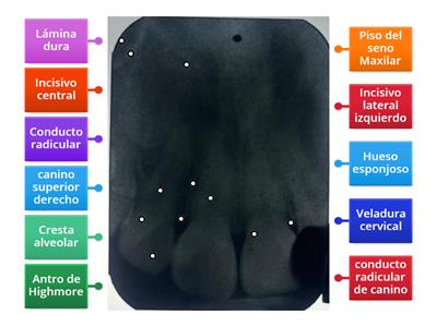 Canino superior izquierdo 